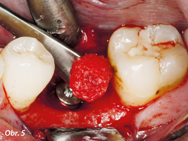 Kostní defekt v okolí implantátu bylo nutno kompenzovat pomocí autogenních kostních úlomků k rekonstrukci obrysu tkání v okolí implantátu.