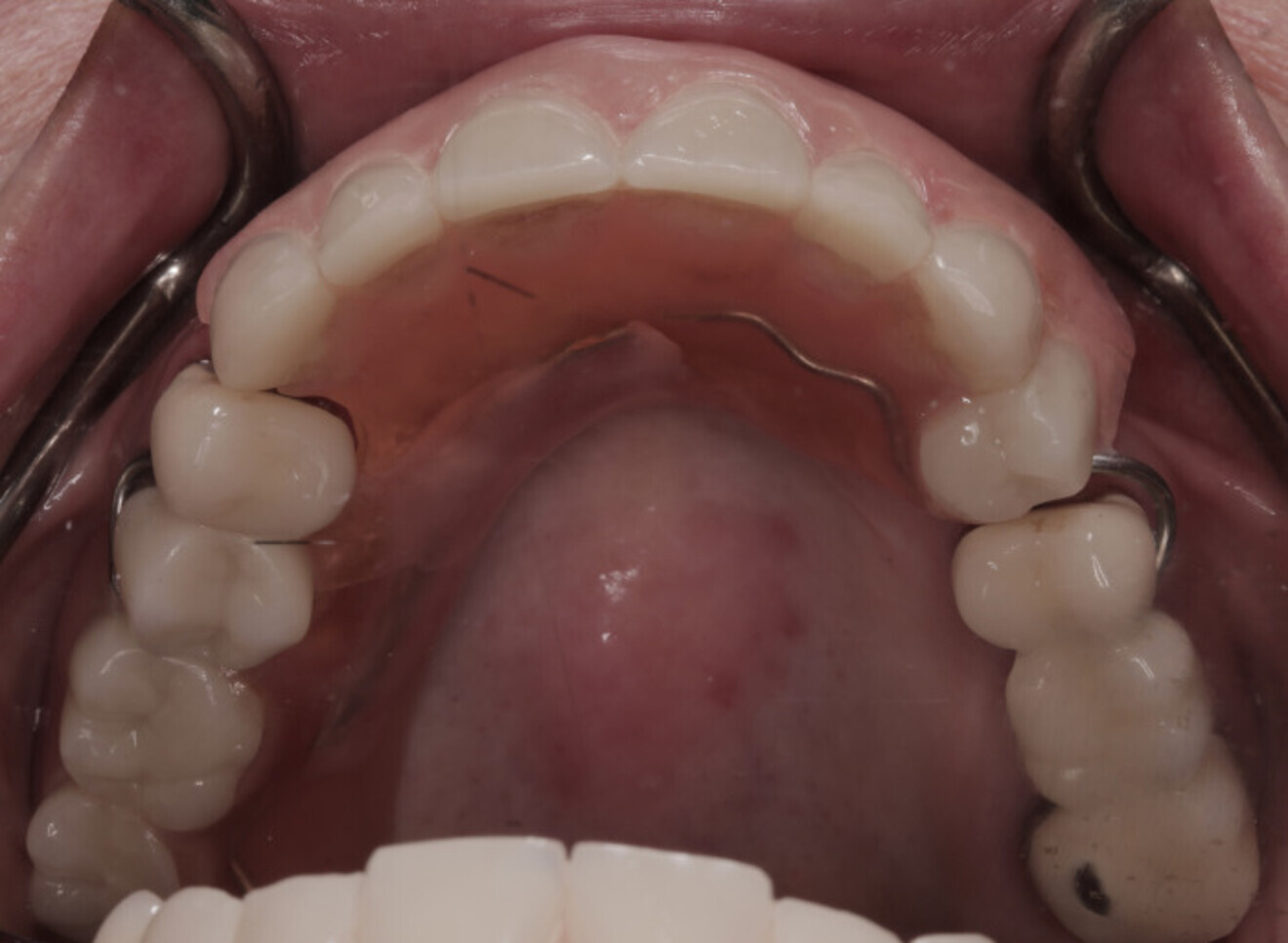 Fig. 3b: Occlusal view of the initial presentation with the partial acrylic denture.