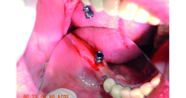 The indispensable use of CBCT in the posterior mandible