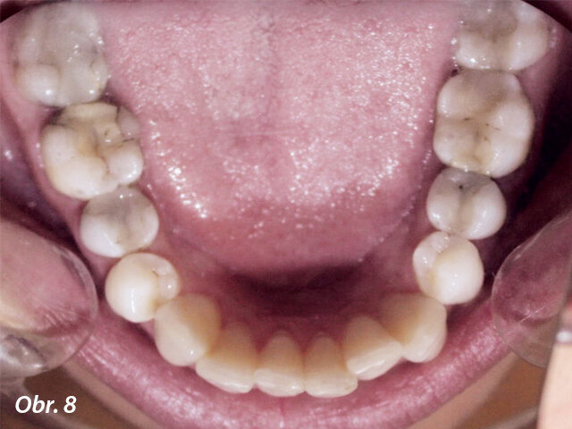 Kazuistika: Lingvální aparát