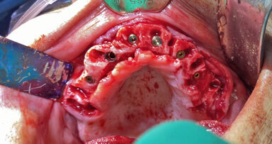 The use of autologous tooth structure as adjunct grafting modality for full-arch dental implant rehabilitation