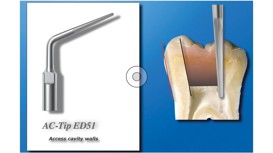 Fig. 5 - - La A-C Tip ED51 è disegnata per la rifinitura delle pareti della cavità d’accesso dei molari superiori e inferiori.