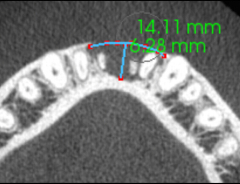 Fig. 5a: Comparison of the horizontal views of the i-CAT scans taken pre-op .... 