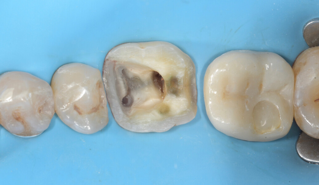Fig. 17: Tooth #36 after removal of the old amalgam restoration, cavity preparation and access cavity creation.