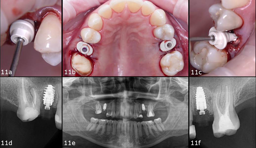 Figs. 11a–f: Placement of a Straumann Anatomic Healing Abutment XC in both sites.