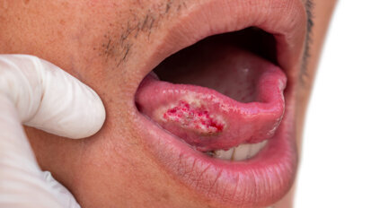 Nghiên cứu xác định những lỗ hổng trong kiến ​​thức của nha sĩ Thổ Nhĩ Kỳ về ung thư miệng và tổn thương niêm mạc