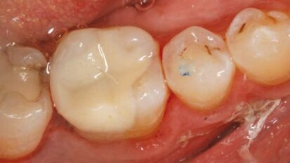 Couronne ou onlay le jour même ?