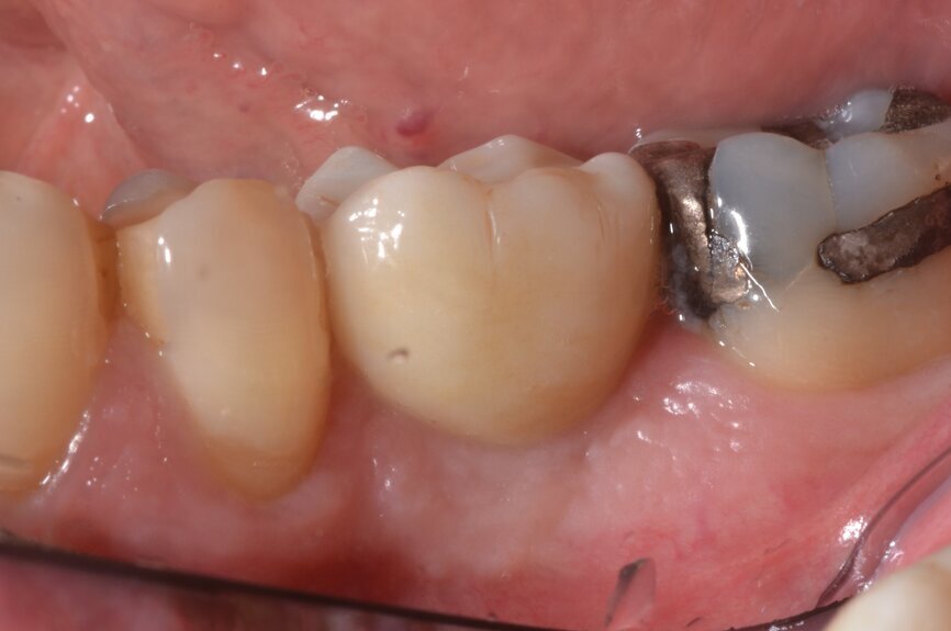 Fig. 18: Final crown in position, lateral view.