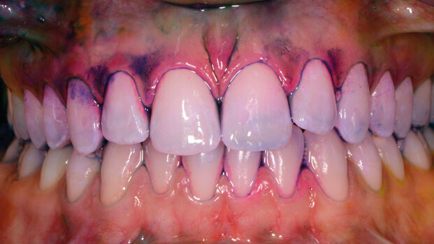 Efficacia ed efficienza del controllo del biofilm orale: protocollo tailoring “personalizzato e condiviso”