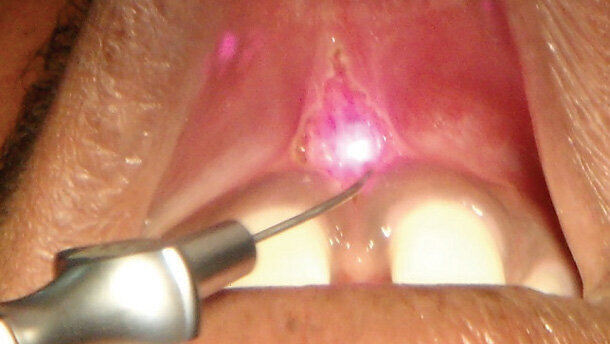 Frenektomie – Srovnání konvenčních technik a diodového laseru