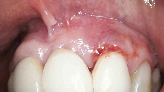 Efficace trattamento di un caso di perimplantite con laser Nd:YAG. Caso clinico