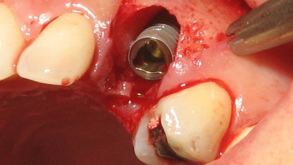 Imedijatna ugradnja implantata u estetskoj zoni