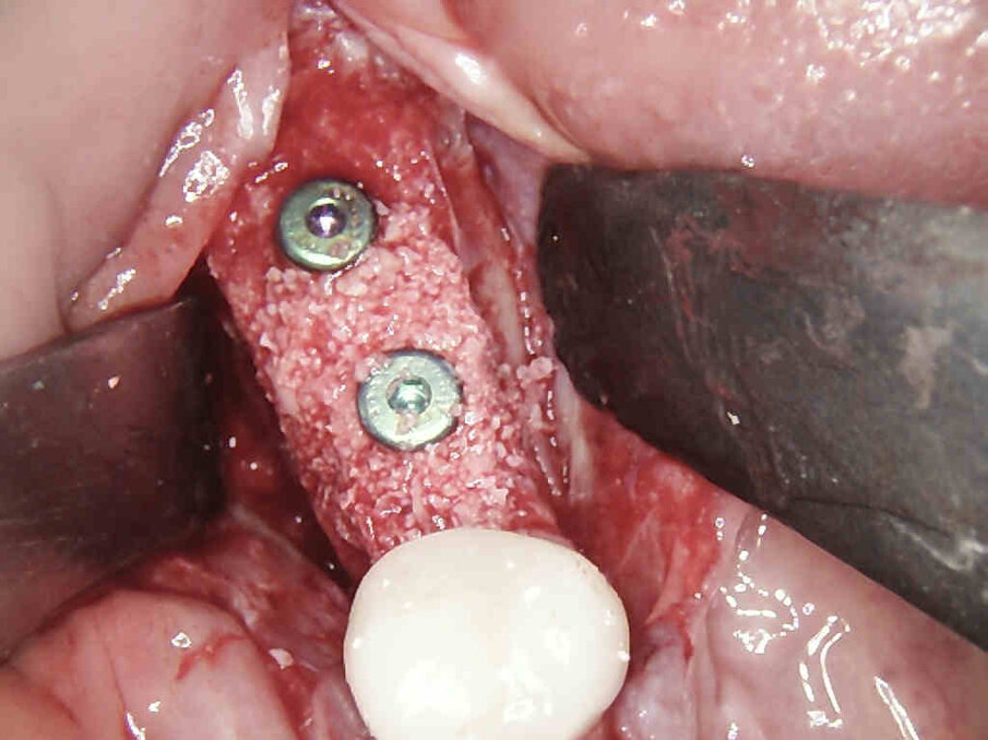 Figg. 13, 14_Viene eseguito il posizionamento degli impianti e la sutura.