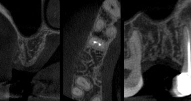 Preservazione della cresta ossea mediante tecnica di Inibizione Periostale Modificata: un caso pilota