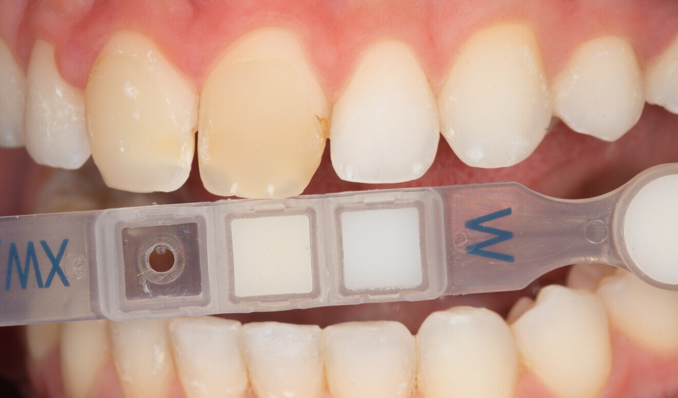 Fig.5 b : Teintier Clearfil Majesty ES-2.