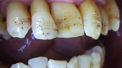 Er:YAG laser conditioning of hypoplastic enamel