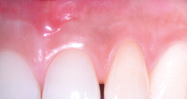 Endodonzia chirurgica: una terapia predittiva e affidabile per conservare il dente naturale