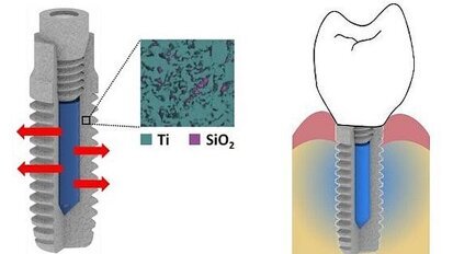 Nieuw implantaat gaat infecties tegen