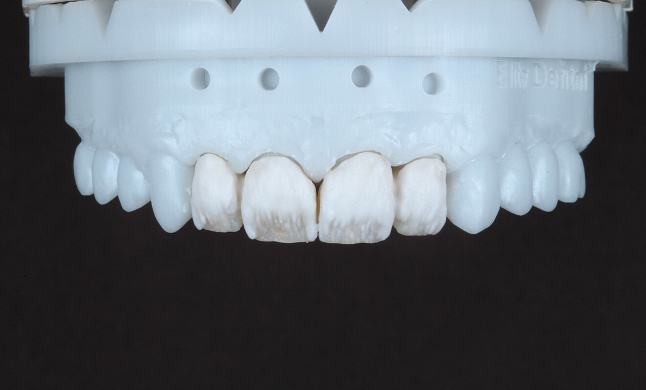 Fig. 8 : Restaurations sur le modèle après stratification au niveau des zones cervicales et des tiers moyens.