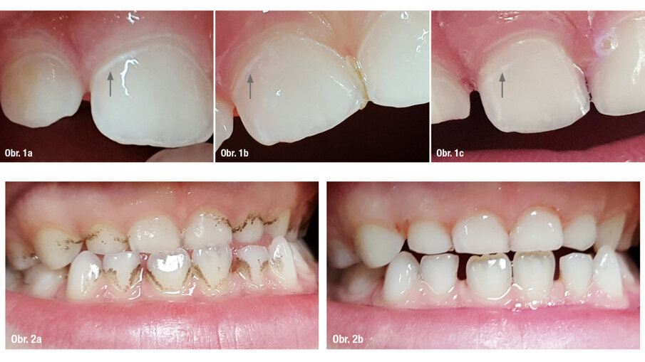 Dítě, 18 měsíců, diagnóza: časný dětský kaz, počínající léze