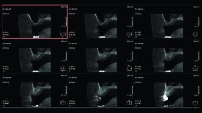 Rialzo di seno con accesso laterale e innesto di impianti autofilettanti SPI in mascellare atrofico
