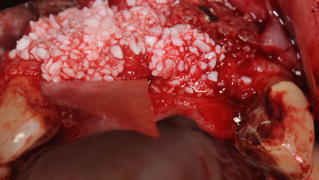 Utilizzo di L-PRF nelle procedure chirurgiche rigenerative: un caso clinico