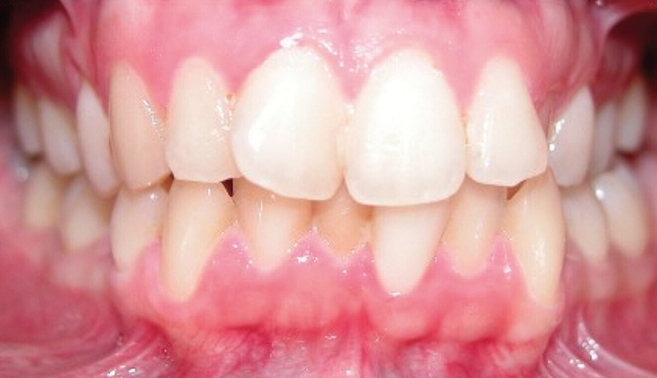 Fig. 1e : Photographie intraorale initiale.