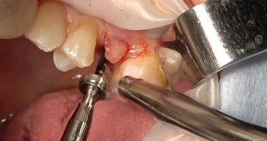 Preservazione della cresta alveolare mediante tecnica LAR con membrana ossea eterologa e spugne di collagene: caso clinico