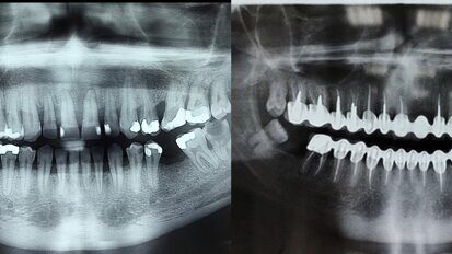 Da li postoji alternativa  sistemskoj antibiotskoj terapiji?