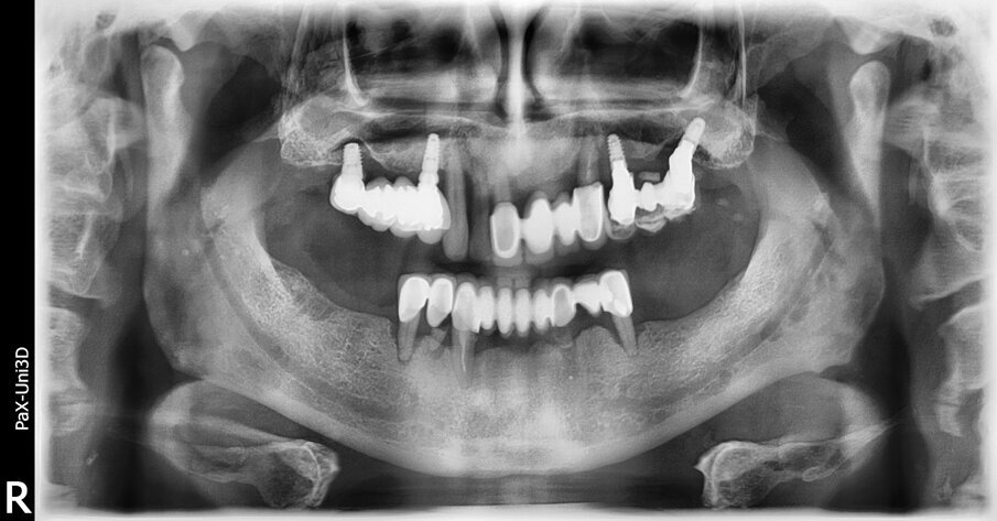 Fig. 1_Ortopanoramica pre-operatoria che evidenzia il grado di riassorbimento osseo. 