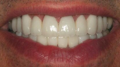 Porcelain laminate veneers: an excellent option to correct esthetic and functional problems