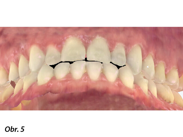 Znázornění okluze.