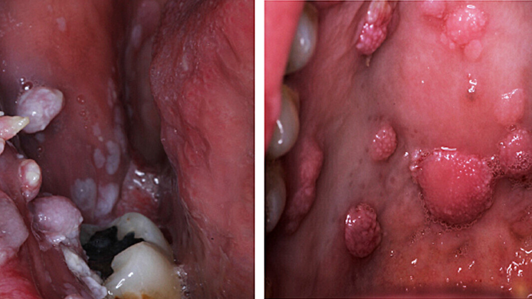 Fig. 6. Verrugas y condilomas. Los pacientes con SIDA suelen presentar múltiples lesiones de VPH en mucosa genital y bucal, asociadas a inmunosupresión.