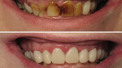 Dúo de expertos: el software y los dientes provisionales Dúo de expertos: el software y los dientes provisionales