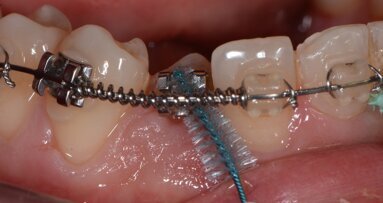 Il controllo del biofilm batterico nello spazio sovracrestale con approccio clinico personalizzato Tailored Brushing Method