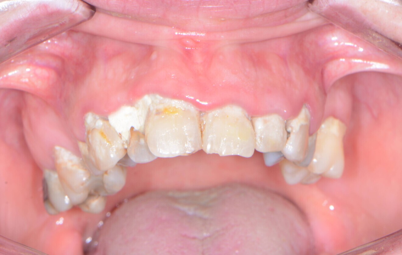 Fig. 1: Pre-op retracted frontal view.