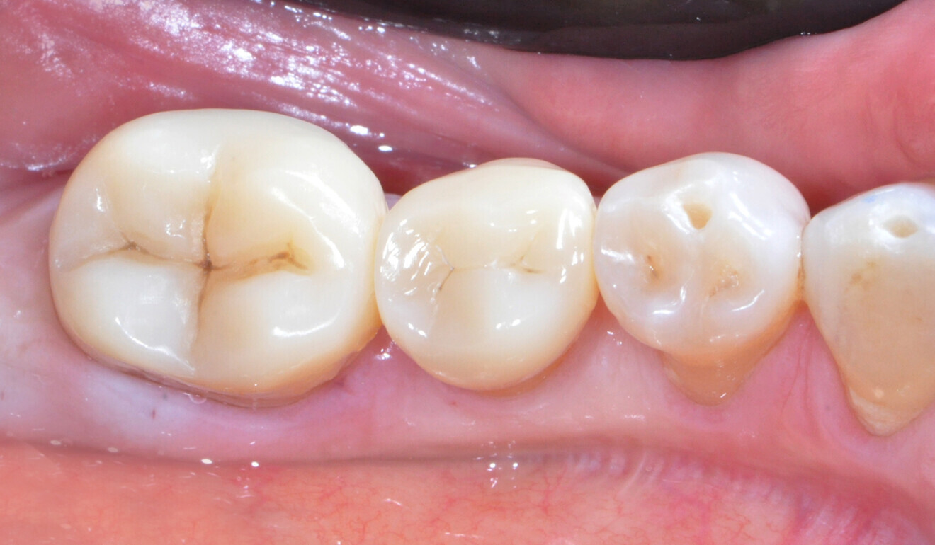 Fig. 29: Treatment outcome, occlusal view. 