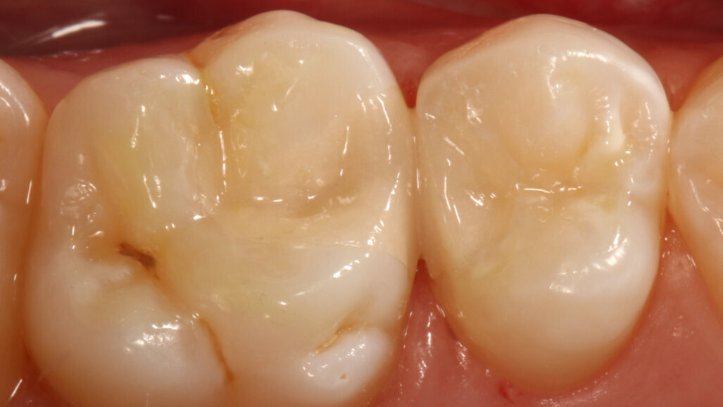 Long-term restorative glass hybrids—eco-friendly and cost-effective evolution from GC