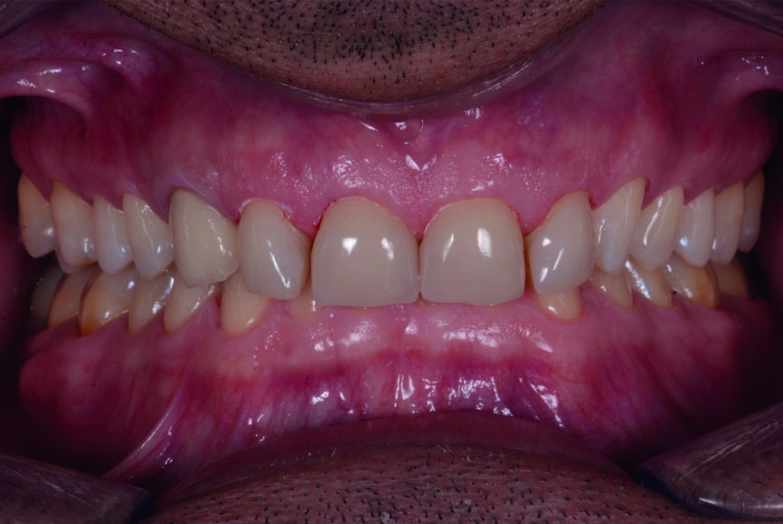 Fig. 1 : Photographie intraorale avant le traitement, prise de face. 