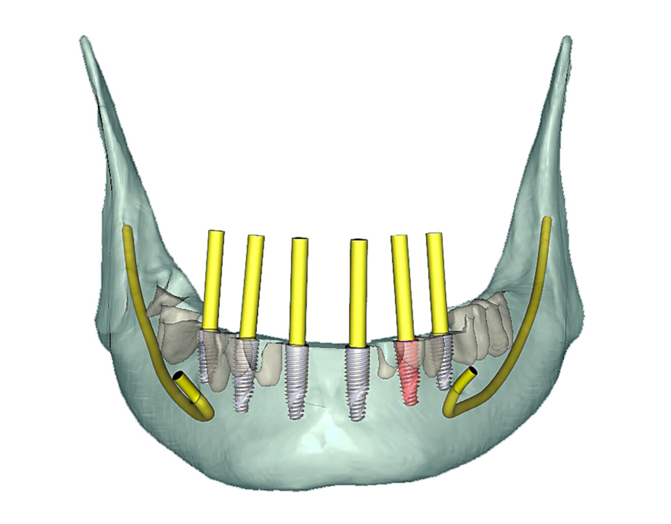 Fig. 15a: Selective transparency view revealing the extent of the necessary bone reduction and simulated implants with yellow abutment projections.