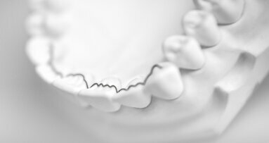 CAD/CAM-fabricated lingual retainers made of nitinol