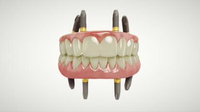 New study findings on Xeal and TiUltra surfaces with All-on-4 treatment concept