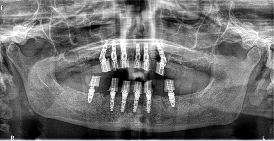 Fig. 16: Post-op panoramic radiograph.