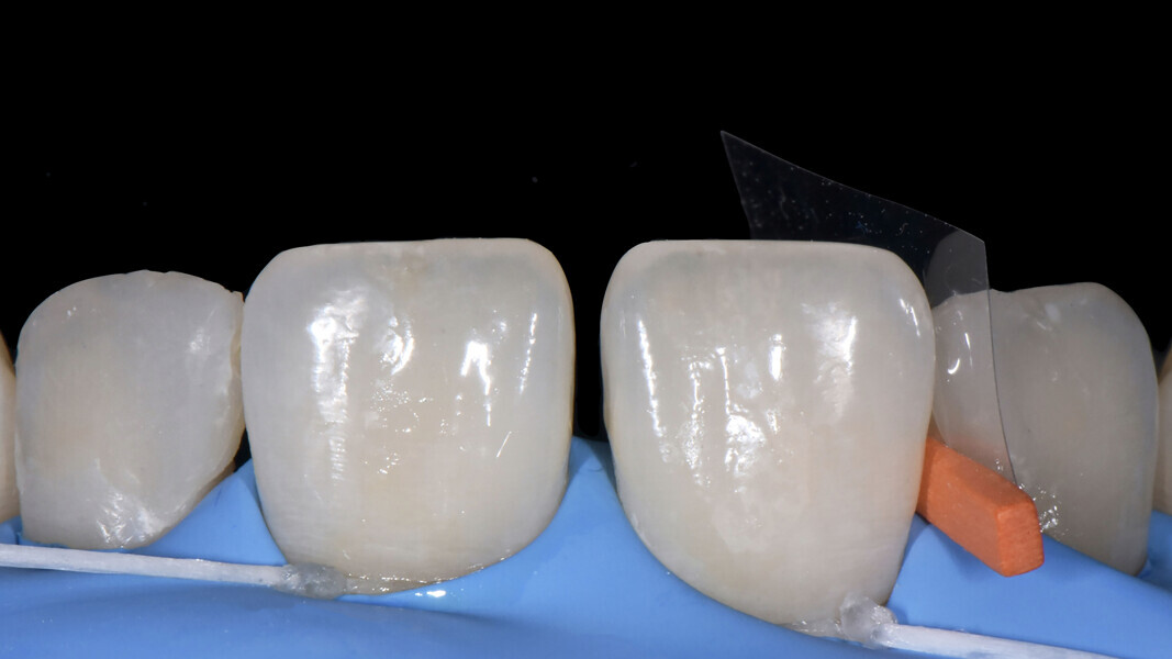Fig. 8: Placement of the wedge and matrix system between teeth #12 and 11.