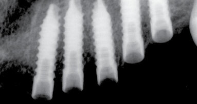 UIS IMPLADENTA – Use for all cases! Užití ve všech případech!