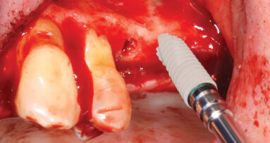 Safe, accurate, simplified sinus lift technique for general practitioners, Part 1: Crestal sinus approach innovation