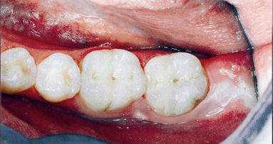 Gli scienziati dichiarano che la CUS è una malattia autoimmune