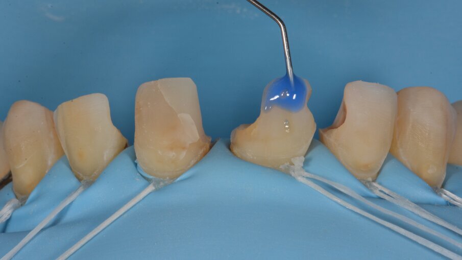 Glazuur werd selectief geëtst gedurende 15 seconden.