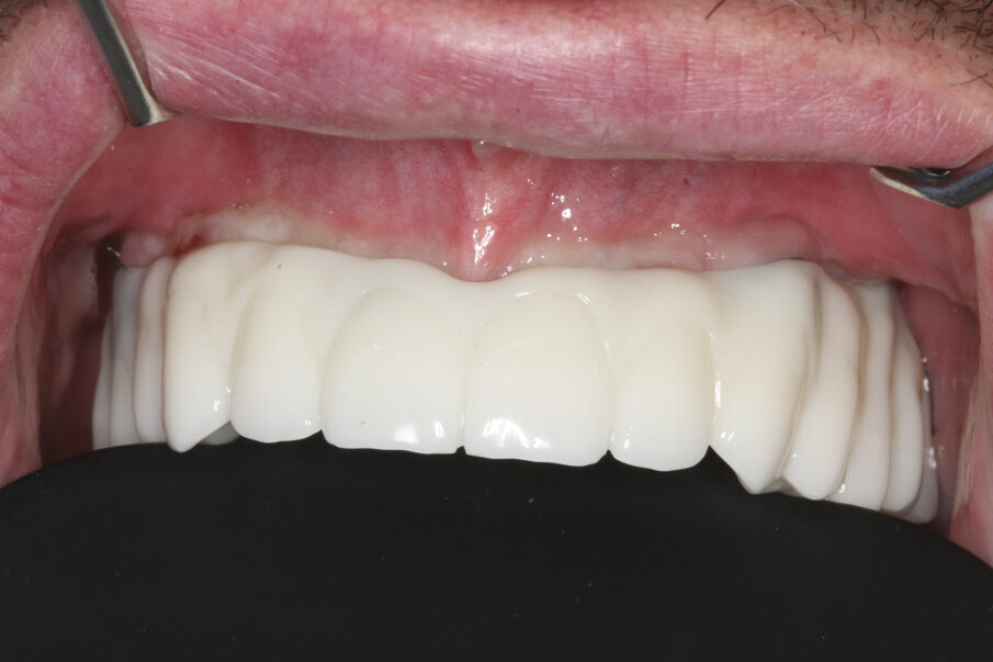 Fig. 16a & b: Try-in of the Atlantis BridgeBase without (16a)... 