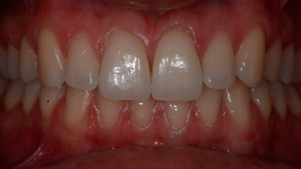 L’adherence ai protocolli operativi di prevenzione con approccio clinico D-BIOTECH (Dental BIOfilm Detection Topographic Technique)